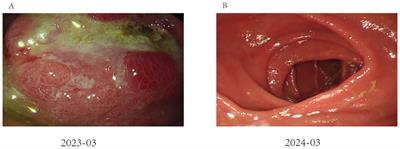 Case report: Significant response of alpha-fetoprotein-producing gastric cancer from combined chemotherapy and immunotherapy